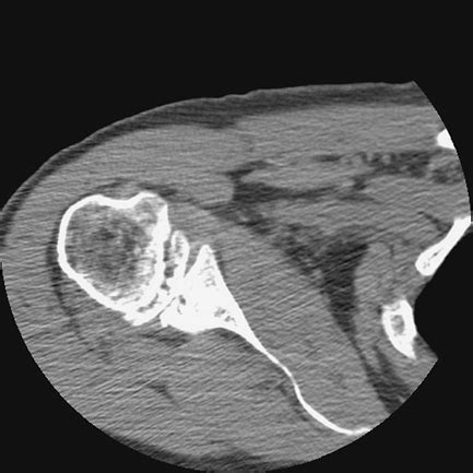 Radial Head Teachme Orthopedics