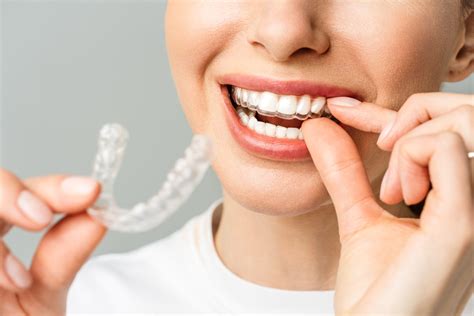 Invisalign Transforma Tu Sonrisa De Forma Discreta Y C Moda Con Los