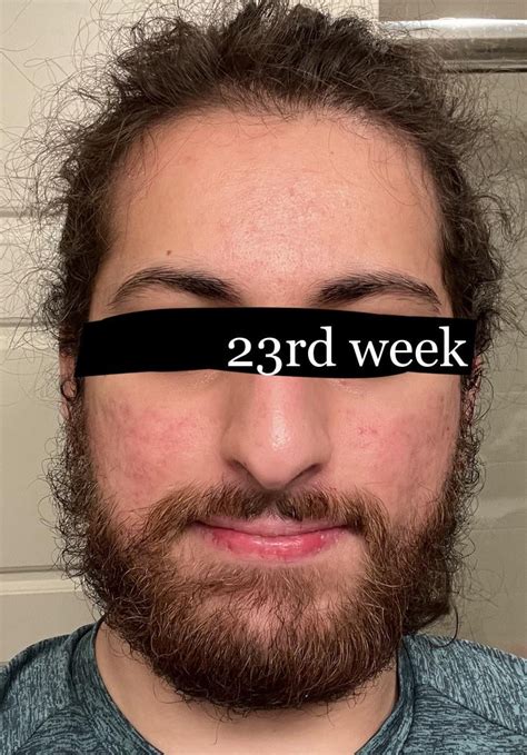 6 Months Of Accutane Before And After Hair Loss Side Effect Tried To