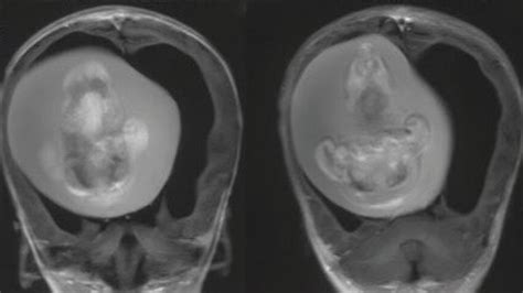 Encuentran el feto vivo de un niño en el cerebro de su hermana