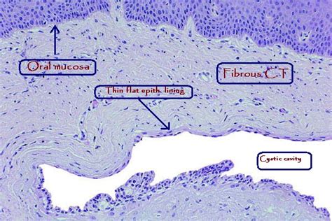 Pathology Outlines - Gingival cyst (adult)