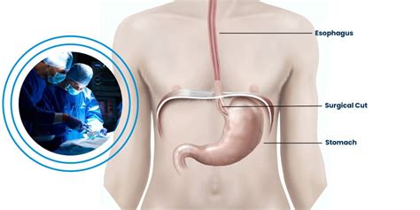 Achalasia Cardia – CIGIS Hospital