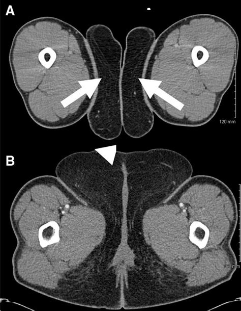 Axial Contrast Enhanced Computed Tomography Angiogram CTA Images Of