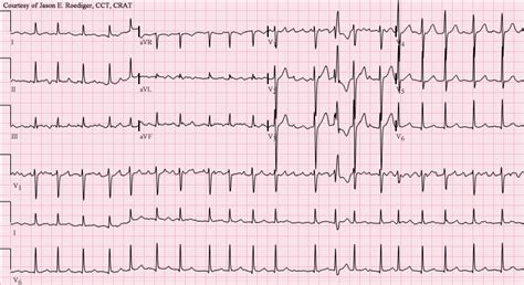 Atrial Fibrillation —