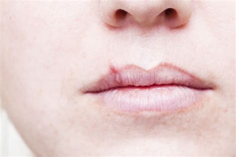 Early Ringworm On Lips Infoupdate Org