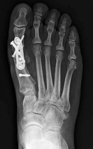 Arthrodesis – Foot and Ankle Institute