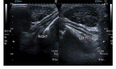 Figure 1 from Detection of duct ectasia of mammary gland by ultrasonography in a neonate with ...