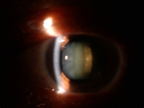 katarak dr ida bagus gde wirastana spmk