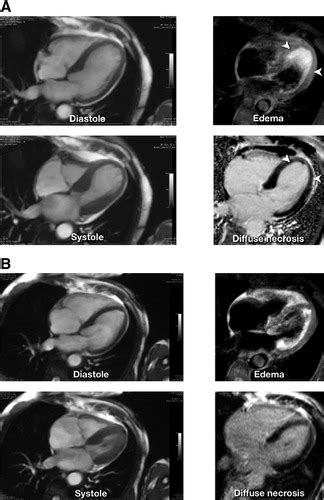 Tissue Characterization Of Acute Myocardial Infarction And Myocarditis