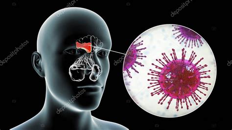 Sinusitis viral inflamación de las cavidades paranasales Ilustración