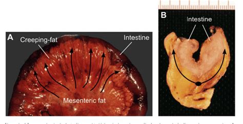 Figure 1 from Visceral fat and gut inflammation. | Semantic Scholar