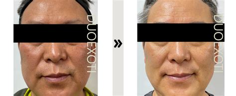 Duoexoti Beforeafter My Bliss Clinic