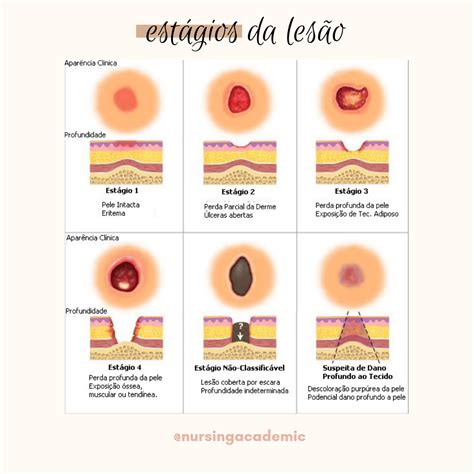 Cid Lesão Por Pressão - RETOEDU