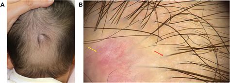 Membranous Aplasia Cutis Congenita A Rare Case Report Highlighting Clinical Presentation