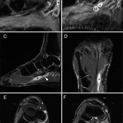 Artistic Rendering The Anatomy Of The Tarsal Tunnel And Pathoanatomy Download Scientific