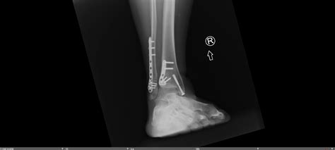 Trimalleolar Ankle Fracture — Chicago Foot And Ankle Orthopaedic Surgeons