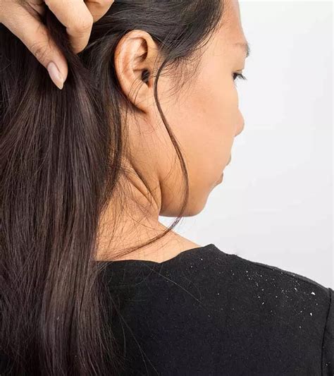 How To Use Apple Cider Vinegar To Cure Dandruff Benefits Side Effects