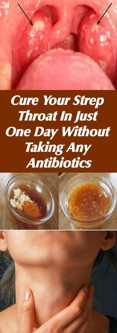 Cure Your Strep Throat In Just One Day Without Taking Any Antibiotics