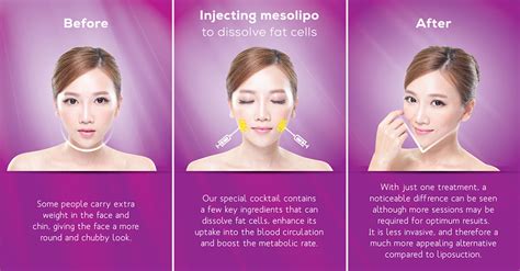 Contouring Meso Lipo Clinic Mf