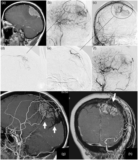 The Safety And Efficacy Of Preoperative Embolization Of Meningioma With