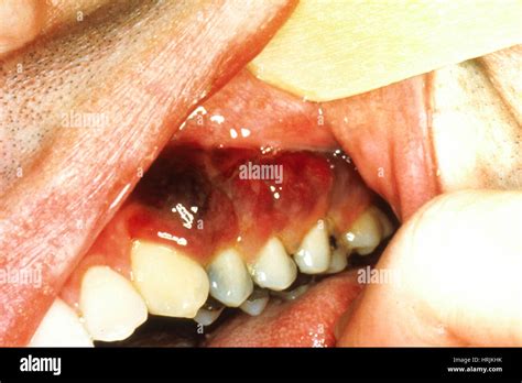 Kaposis Asociada A Sarcoma Fotografías E Imágenes De Alta Resolución