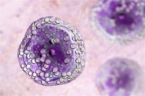 Diffuse large B-cell lymphoma Prognosis - Rare Disease Advisor