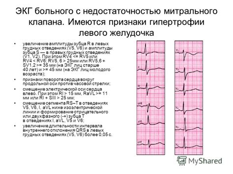 Недостаточность митрального клапана фото
