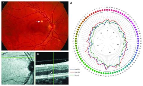 After Resolution Permanent Damage Remained To The Inner Retinal