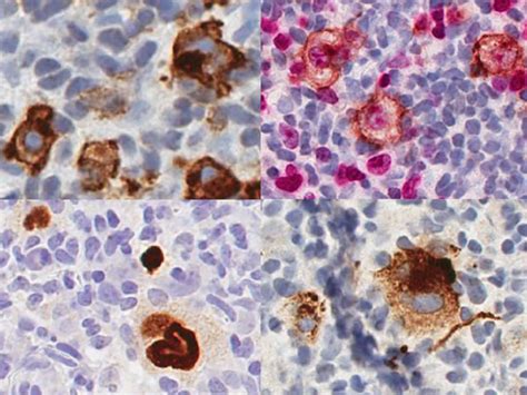 EBV CHL Left Upper CD30 Cytoplasmic Golgi And Membranous