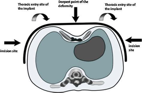 Figure 3 From Minimally Invasive Repair Of Pectus Excavatum Using The