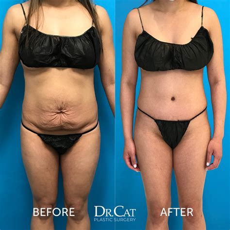 360 Liposuction Vs Tummy Tuck