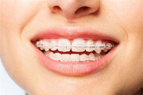 Effaf Di Teli Tedavisi Effaf Plak Invisalign Telsiz Tedavi