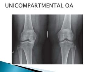 unilateral knee replacement vs high tibial osteotomy. | PPT