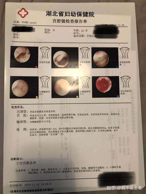 子宫内膜息肉宫腔镜手术过程（二次复发及治疗） 知乎