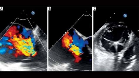 Pascal Tricuspid Repair Outcomes Durable At 1 Year Clasp Tr