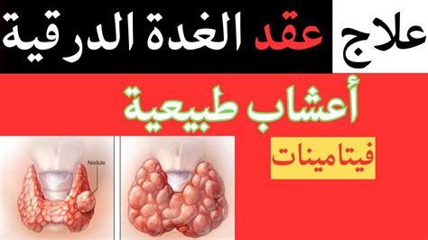 علاج طبيعي أعشاب عقد عقيدات الغدة الدرقية فيتامينات Youtube