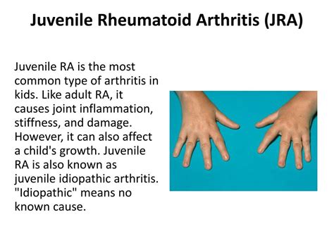 Juvenile Rheumatoid Arthritis