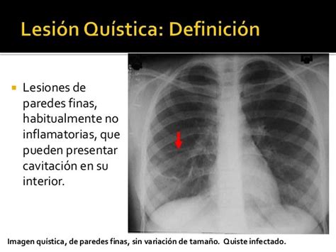 Lesiones Cavitarias Y Quísticas Del Pulmón