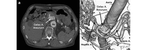 a, Computed tomography (CT) scan shows the aneurysm of the celiac ...