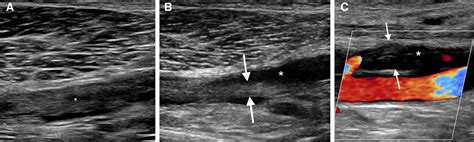 Ultrasound For Lower Extremity Deep Venous Thrombosis Circulation