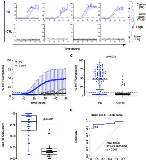 Rt Quic Detection Of α Syn Seeding Activity In Skin Biopsies From Pd