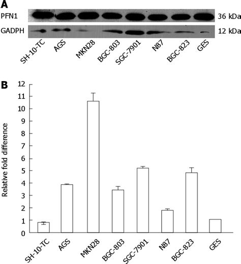 Figure 2 From Silencing Profilin 1 Inhibits Gastric Cancer Progression