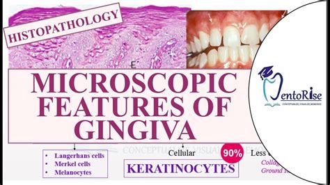 Microscopic Features Of Gingiva Histopathology Of Gingiva Gingiva