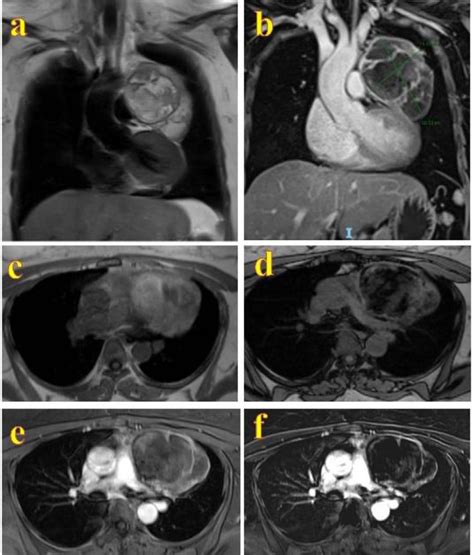 Case Mediastinal Mature Cystic Teratoma In A Year Old Woman
