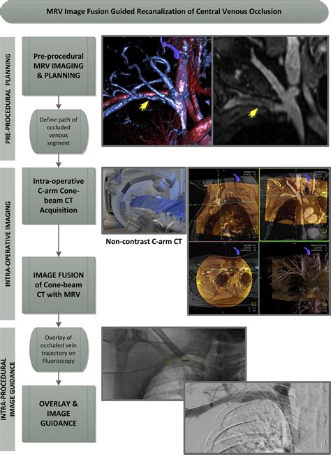 Magnetic Resonance Venography And Three Dimensional Image Fusion