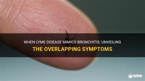 When Lyme Disease Mimics Bronchitis Unveiling The Overlapping Symptoms