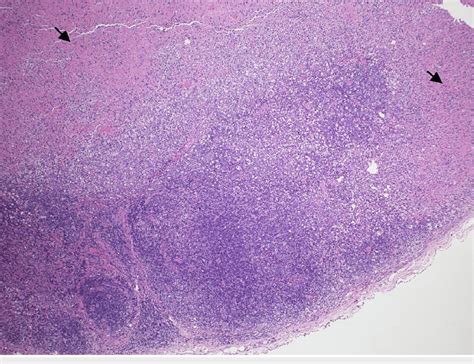 Light Microscopic Examination Showing A Lymph Node With Patchy Necrotic