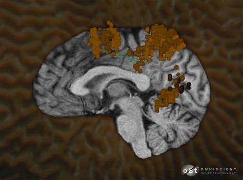 The Dorsal Attention Network