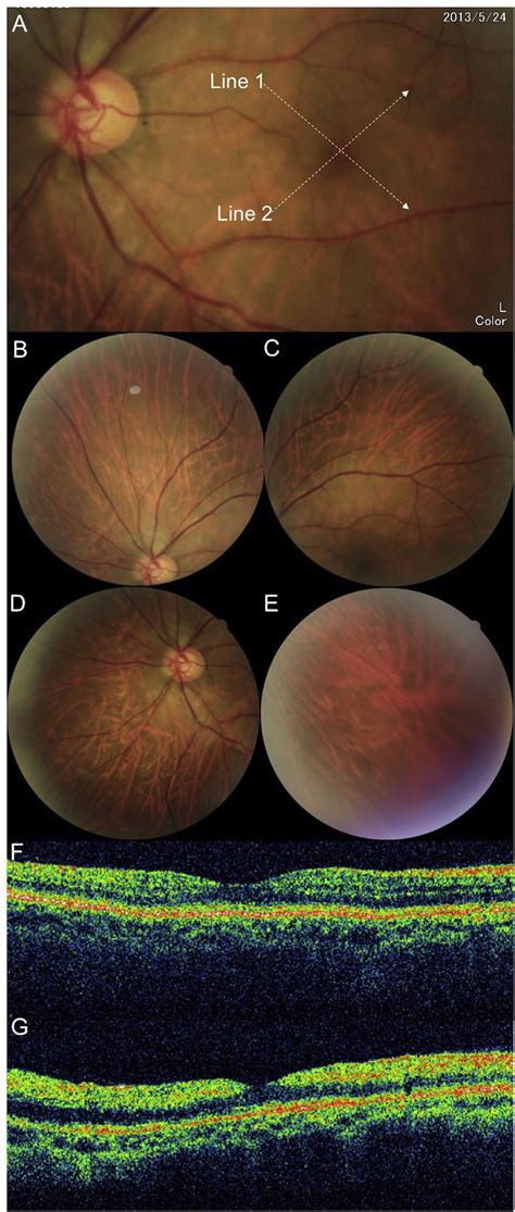 Left Color Fundus Photographs And Optical Coherence Tomography Scanning Download Scientific