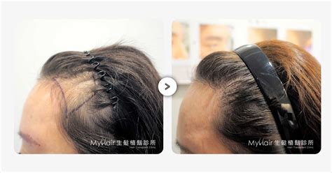 醫美從業者精益求精 打造想要完美的髮際線 Myhair生髮植鬍診所